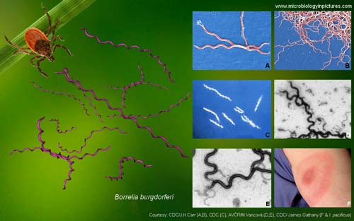 Borrelia Burgdorferi