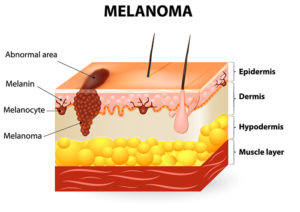 Diagram of Melanoma