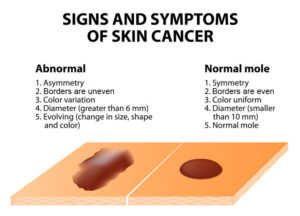 Skin Cancer Signs - ABCDEs