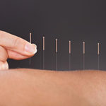 Acupuncture Needles