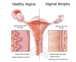 Healthy Vagina vs Vaginal Atrophy