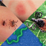 Ticks, Lyme Rash, Borrelia burgdorferi